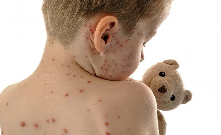 Sağlık Bakanlığı’ndan “kızamık” alarmı: 81 ile yazı gönderildi